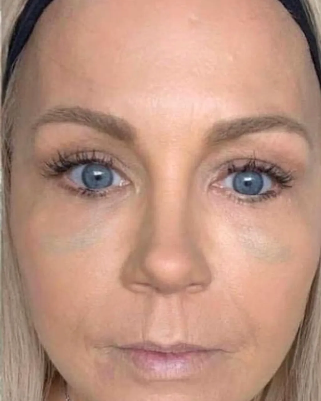 The same client after a hydro facial, with brighter, smoother, better-hydrated skin