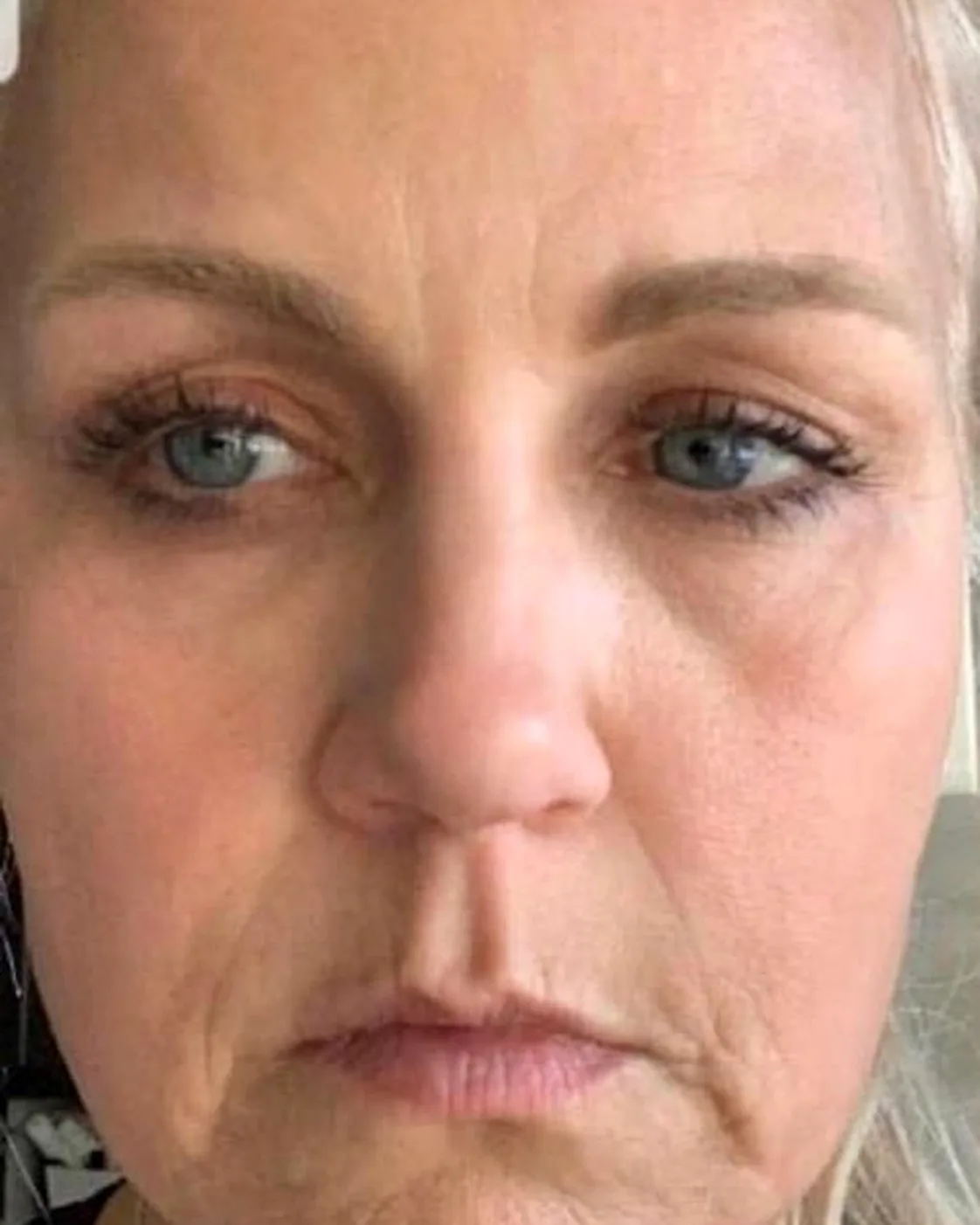 Client's face before a hydro facial, with dull, dehydrated-looking skin and visible lines