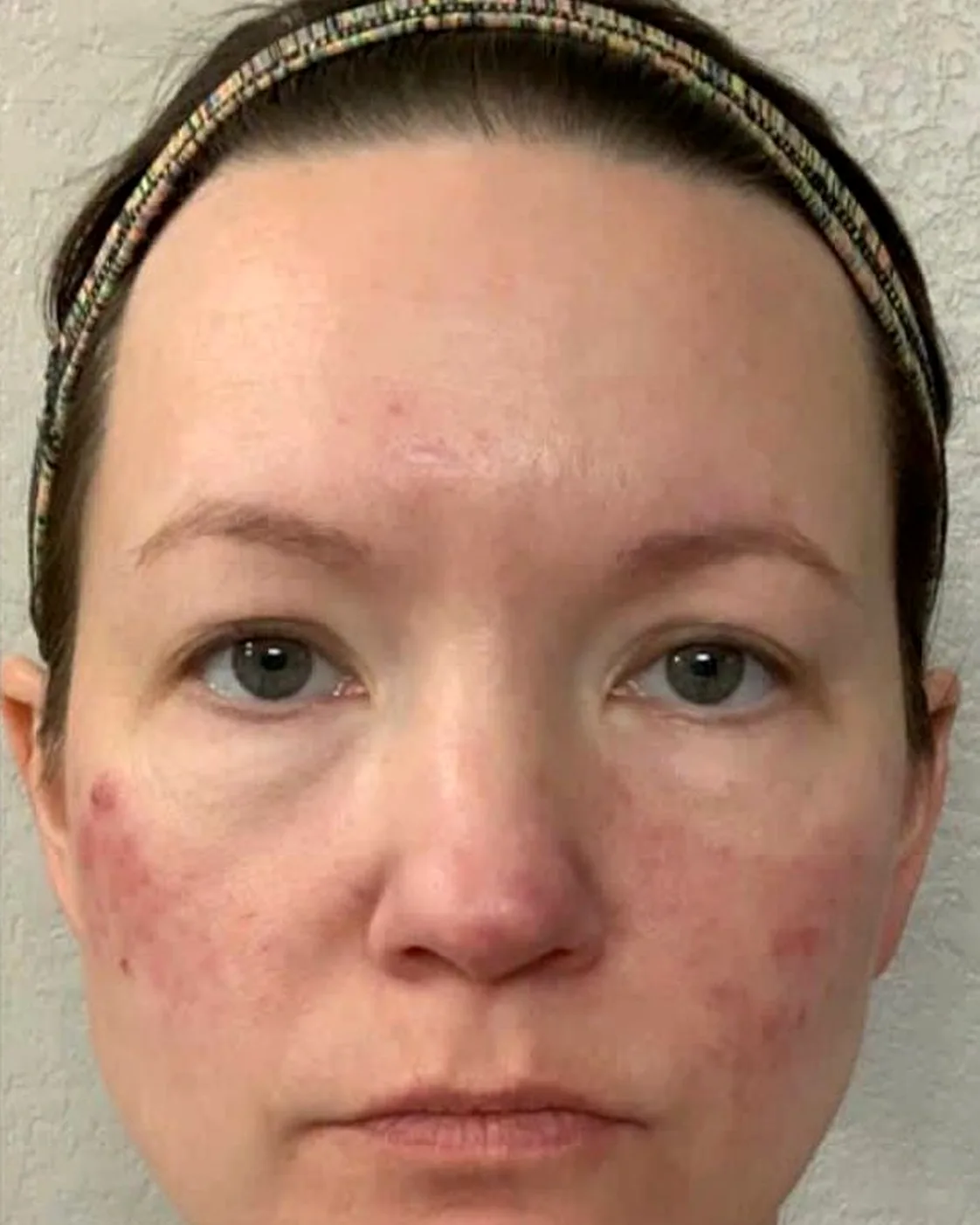The same client after microneedling, with calmer skin and more even tone across the cheeks