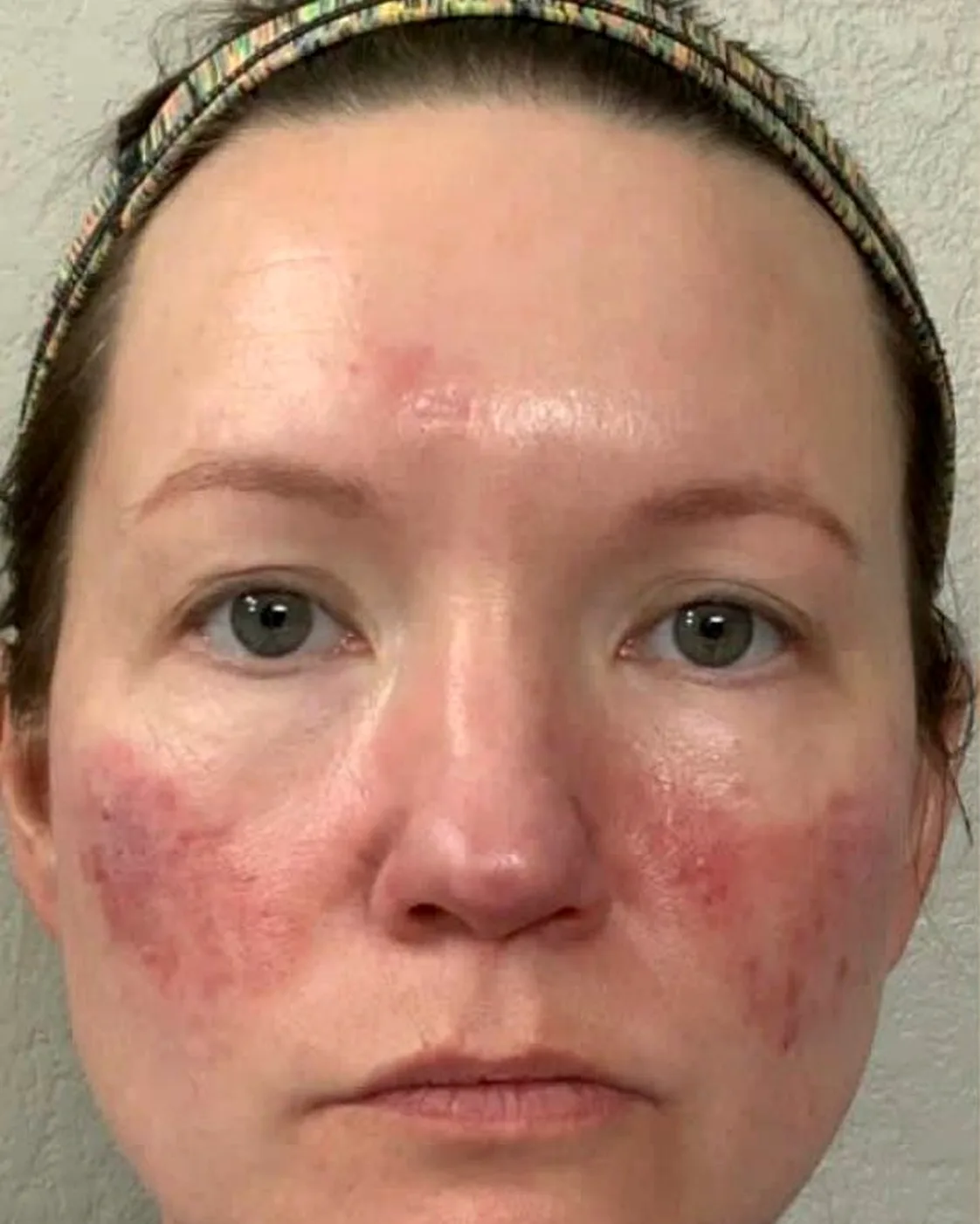 Client's face before microneedling, with redness and visible texture across both cheeks