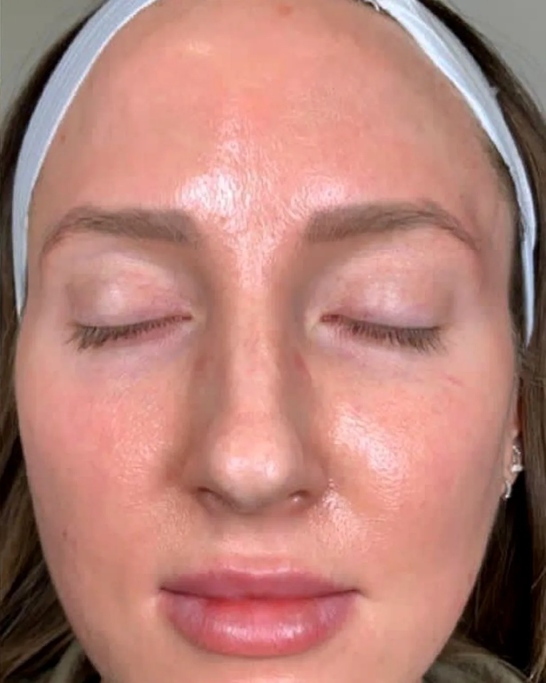 The same client after a nano infusion facial, with clearer, more even and hydrated skin