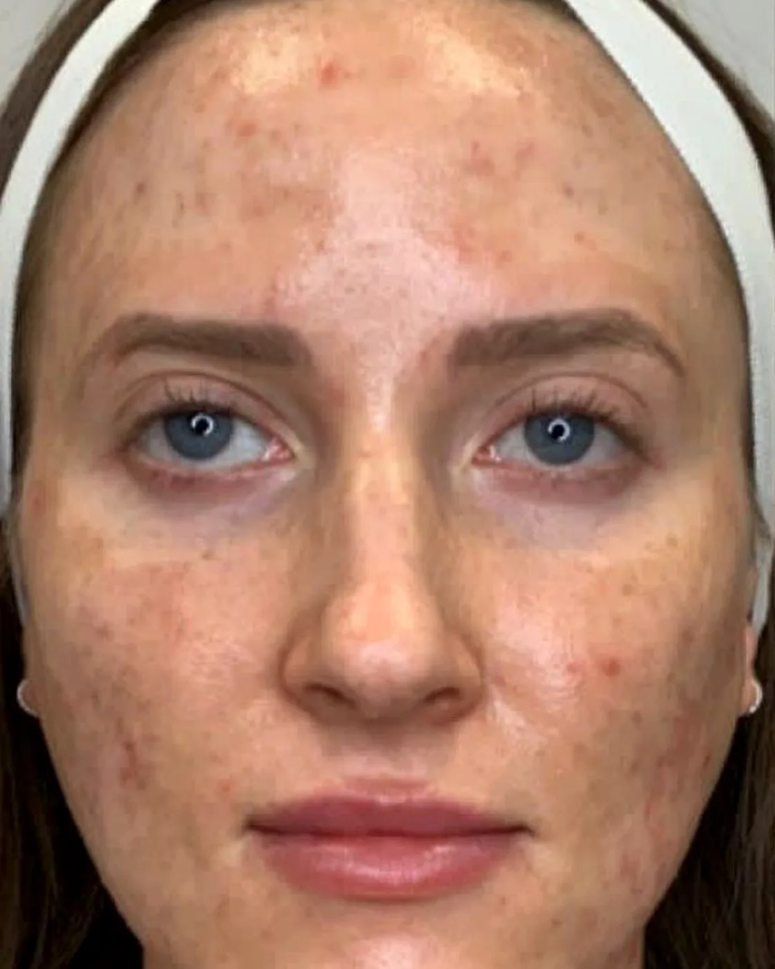 Client's face before a nano infusion facial, with uneven tone, dark spots and blemishes