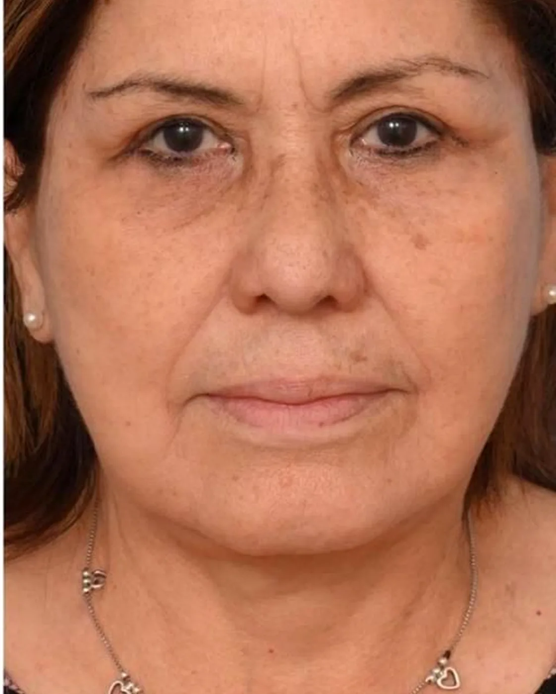 The same client after RF skin tightening, with a more defined jawline and firmer neck