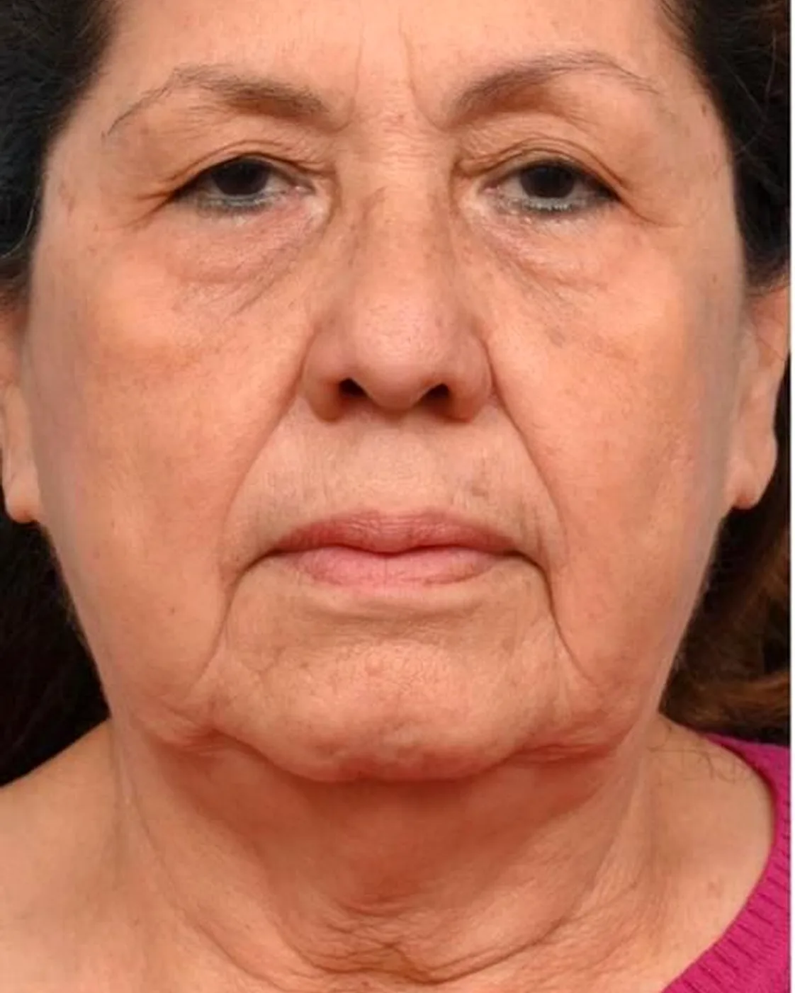 Client's face and neck before RF skin tightening, with loose skin along the jawline and neck